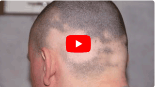 Vital Center Kroker Video zur Indikation Alopezie (Haarausfall)