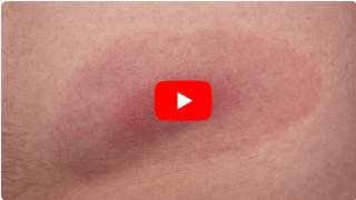 Vital Center Kroker Video zur Indikation Lyme-Borreliose